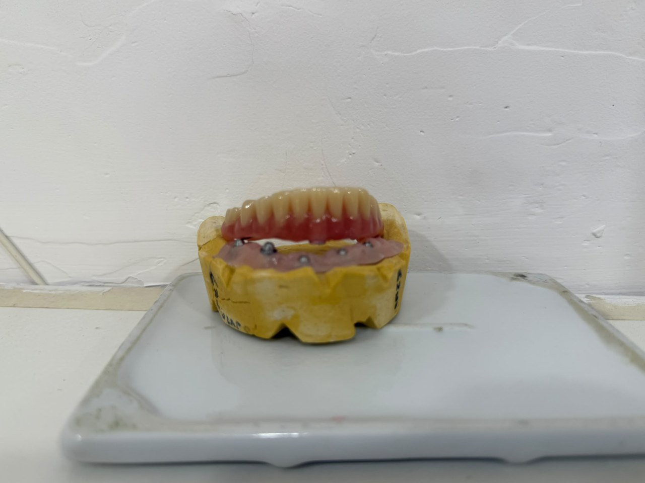 Prótesis híbrida sobre implantes