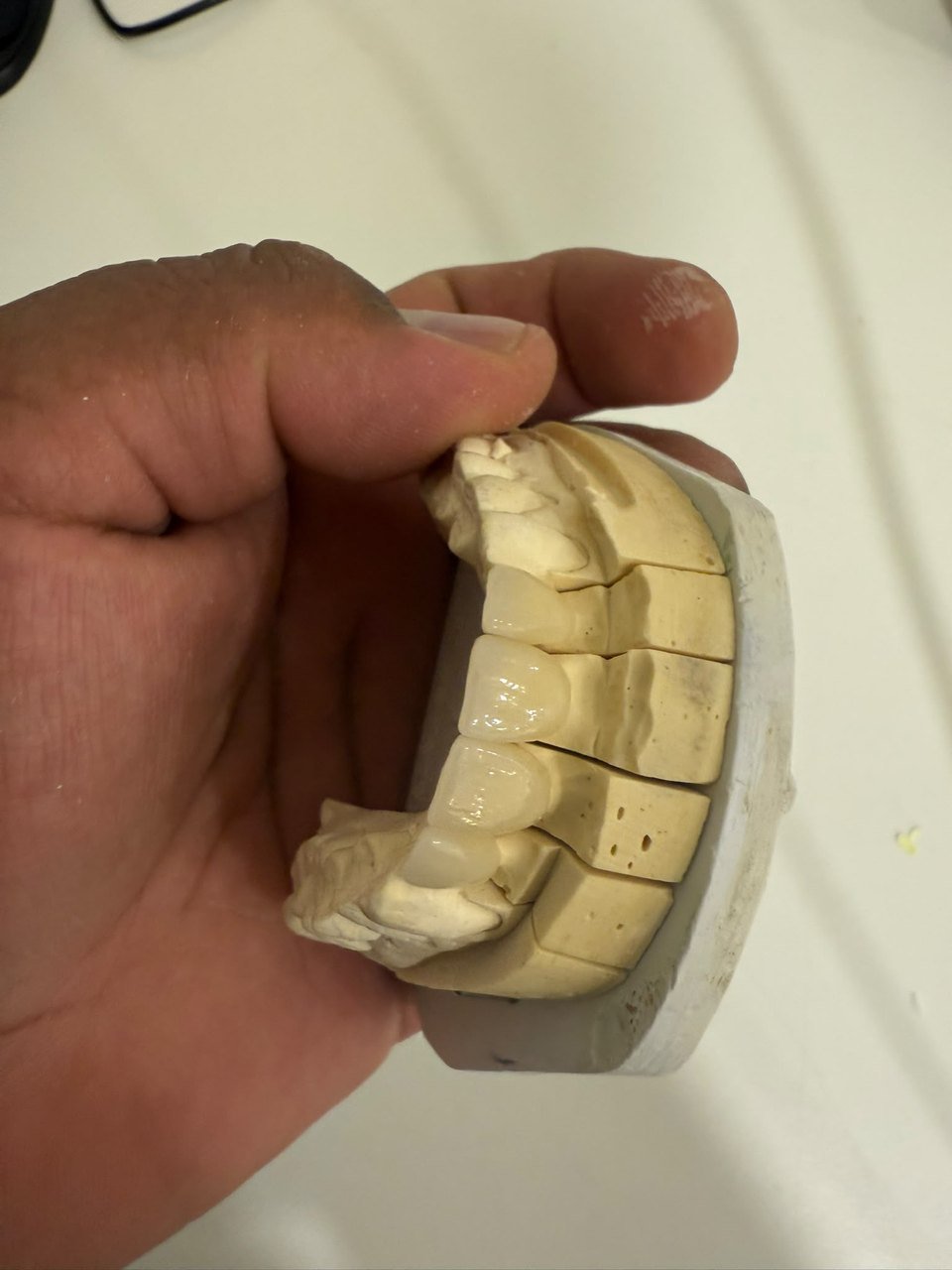 Estructura atornillada sobre implantes