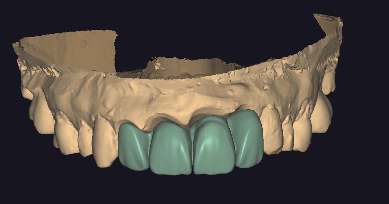 Diseño digital de un puente dental
